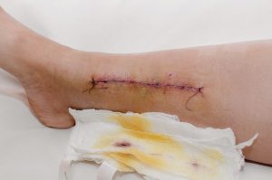 Suture on a damaged leg after surgery.