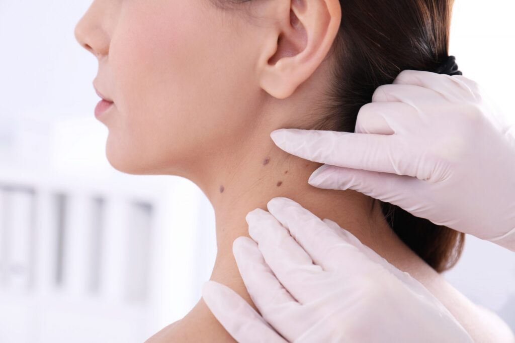 closeup of physician's hand examining moles on neck