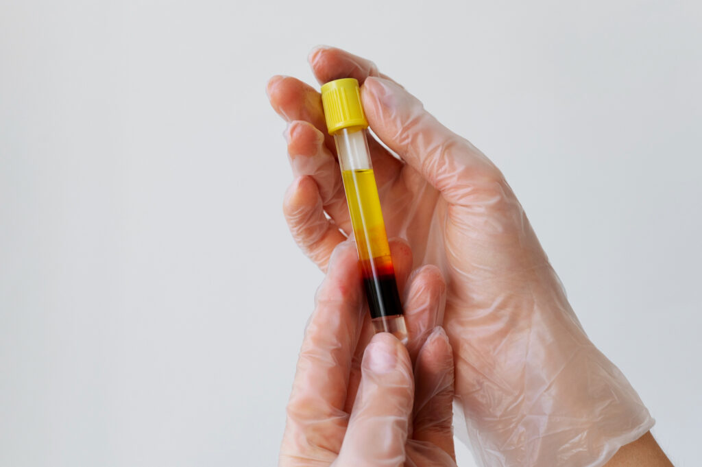 closeup of hands holding vial for PRP treatments